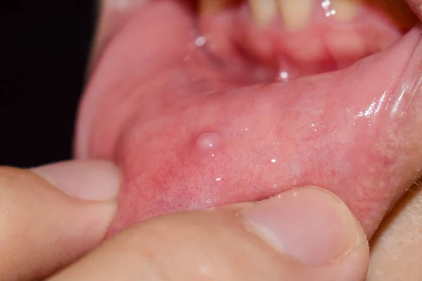 Small vesicle lesion at lower lip of Asian man.