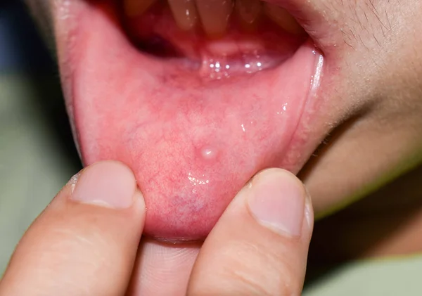 Small vesicle lesion at lower lip of Asian man.