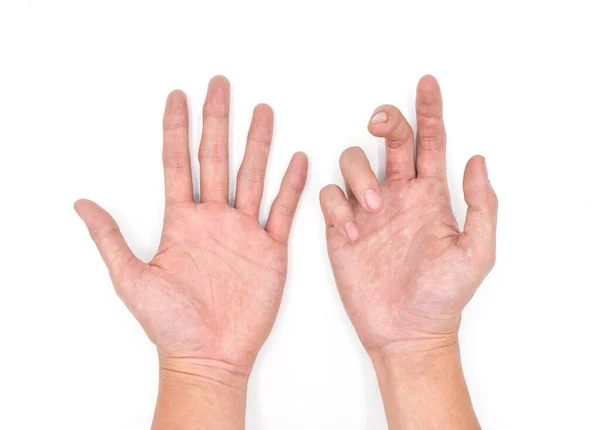 Asyalı genç bir adamın normal eliyle karşılaştırıldığında Ulnar el pençe. Ayrıca 