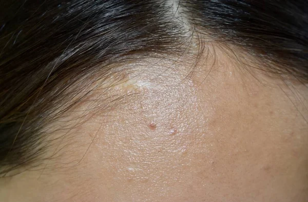 Oily skin with wide forehead of Southeast Asian, Myanmar or Korean adult young woman.