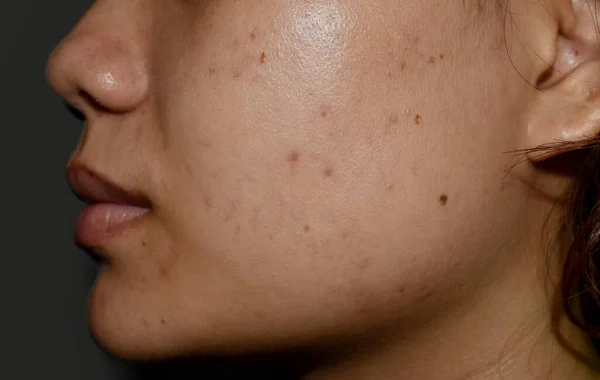 Cloasma Melasma Manchas Negras Cicatrices Acné Cara Una Joven Asiática —  Fotos de Stock