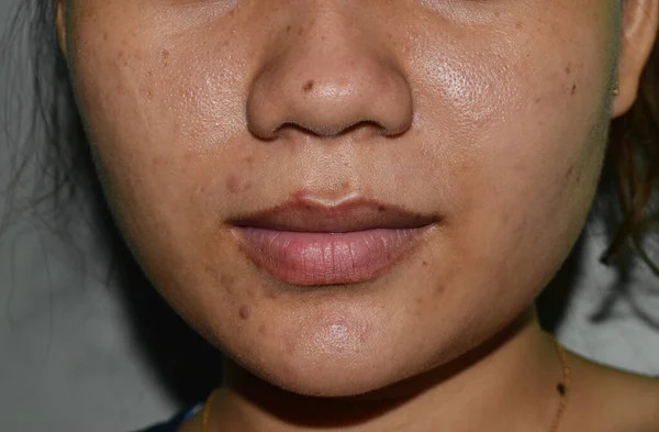 Acne Manchas Pretas Cicatrizes Rosto Jovem Mulher Asiática — Fotografia de Stock