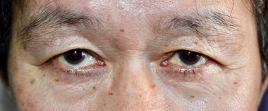 Skin creases around the eyes of Asian elder man showing aging.  clipart