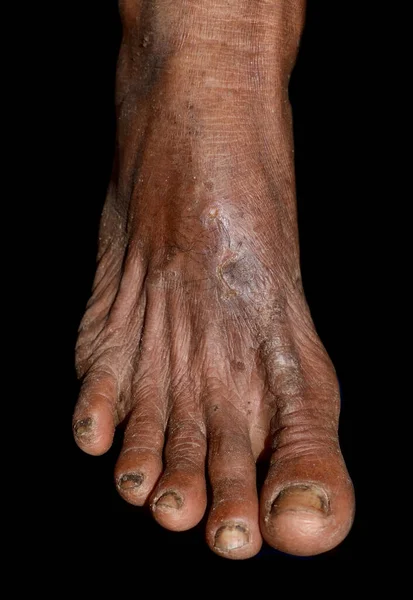 Έκζεμα Μυκητιασική Λοίμωξη Στο Πόδι Του Ασιατικού Ανθρώπου — Φωτογραφία Αρχείου