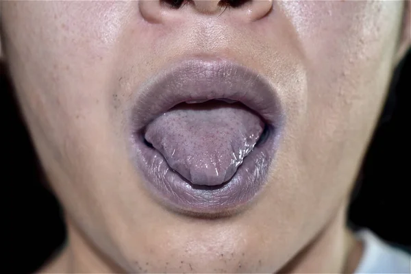 Labios Cianóticos Cianosis Central Sudeste Asiático Joven Con Cardiopatía Congénita —  Fotos de Stock