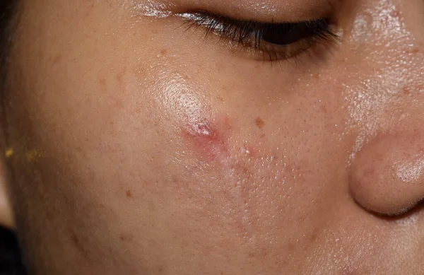 Acne Zwarte Vlekken Littekens Het Gezicht Van Aziatische Jonge Vrouw — Stockfoto