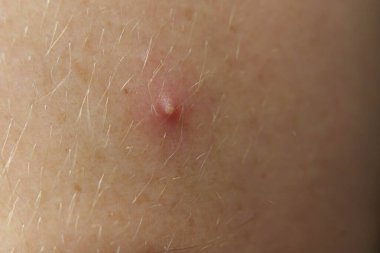 Closeup of a red pimple on human skin, showing inflammation and acne with visible hair and pores. High quality photo