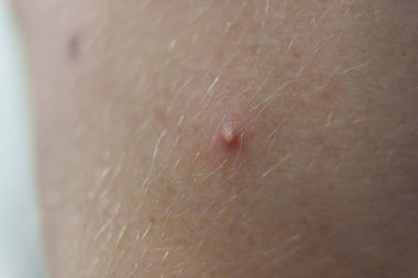 Closeup of a red pimple on human skin, showing inflammation and acne with visible hair and pores. High quality photo
