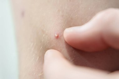 Fingers pressing on a small pimple on human skin, showing acne and skin imperfections up close. High quality photo