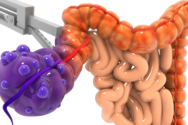 白色背景的阑尾手术 3D渲染 — 图库照片
