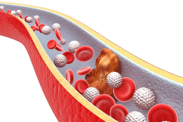 Placca Colesterolo Nell Arteria Rendering — Foto Stock