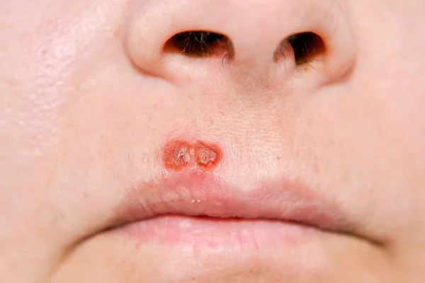Herpes virüsü