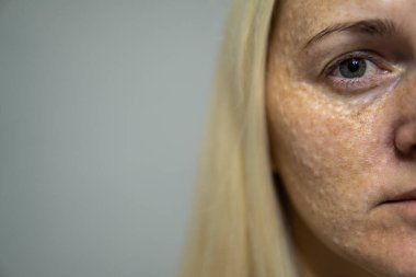 Mezoterapiden sonra kadının yüzü. Güzellik iğneleri. yüksek kalite