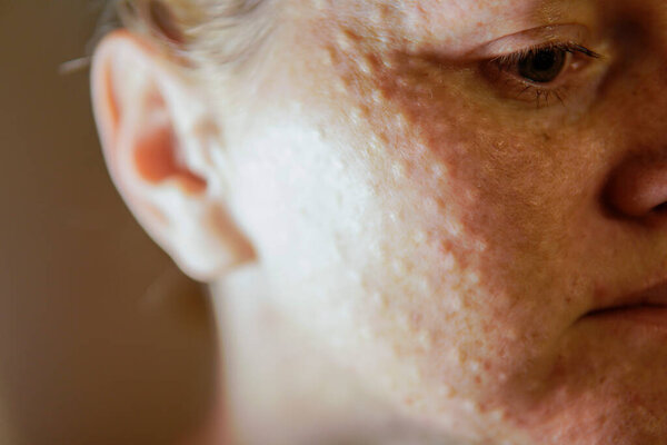 Лицо женщины после инъекций мезотерапии биоревитализация. инъекции красоты. высокое качество