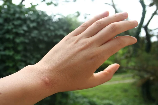 Mosquito Bite Female Adult Hand Garden — Stock Photo, Image