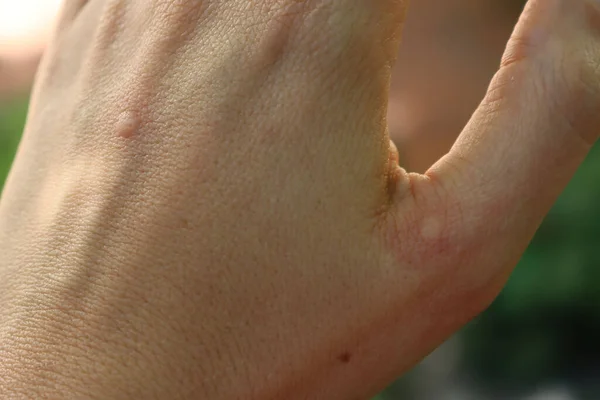 Duas Picadas Mosquito Uma Mão Adulta Feminina Fundo Embaçado — Fotografia de Stock