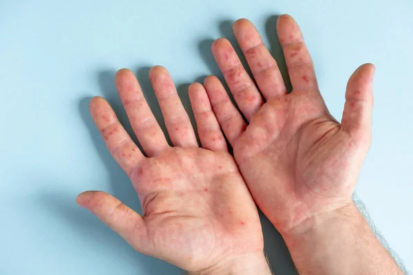 Painful rash, red spots blisters on the hand. Close up Allergy rash, human hands with dermatitis and Health problem. Ill eczema skin of patient. Viral Diseases. Red rashes on the palm. Enterovirus