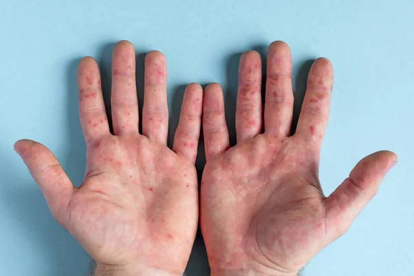 Painful rash, red spots blisters on the hand. Close up Allergy rash, human hands with dermatitis and Health problem. Ill eczema skin of patient. Viral Diseases. Red rashes on the palm. Enterovirus