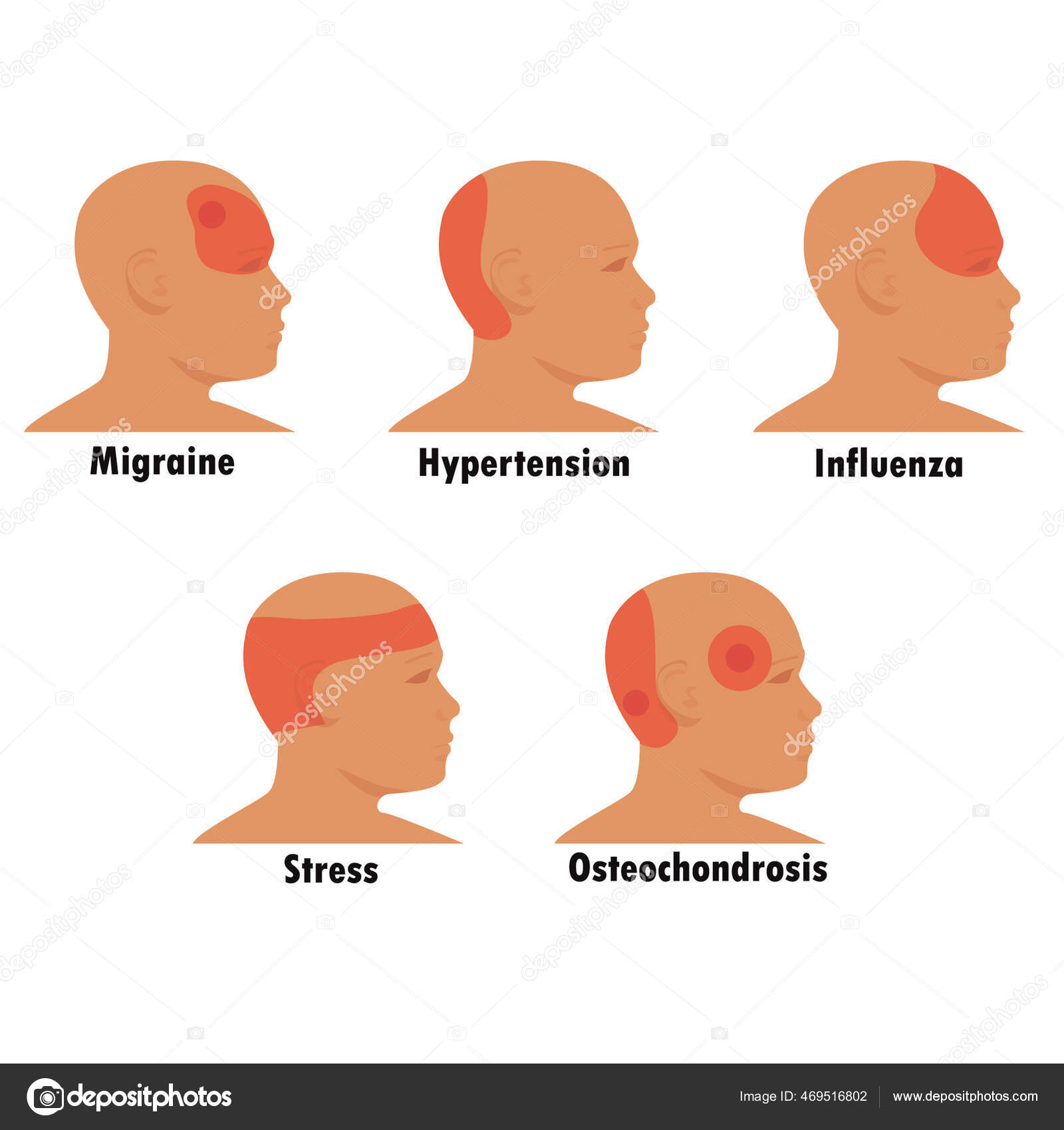 Боль в затылке причины у мужчин. Головная боль схематически. Схематическое изображение головной боли. Локализация боли в голове. Очаги боли в голове.