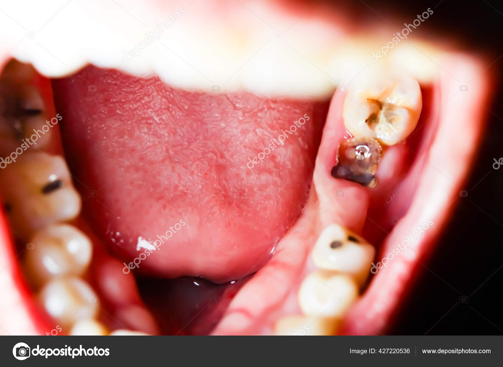 Early Stages of Tooth Decay | Spotting Tooth Decay Symptoms