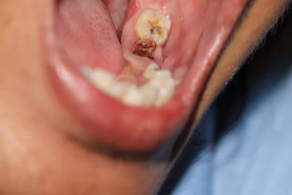 Κοιλότητες Και Σπασμένα Δόντια Είναι Επώδυνα — Φωτογραφία Αρχείου