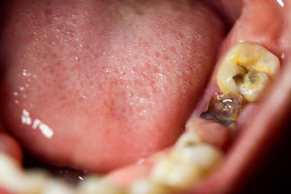 Кости и сломанные зубы болезненны.