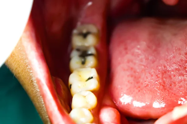 Las Caries Los Dientes Rotos Son Dolorosos — Foto de Stock