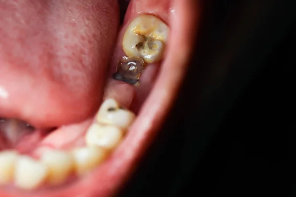 Cavities Broken Teeth Painful — Stock Photo, Image