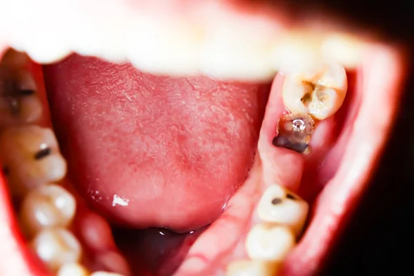 Hohlräume Und Kaputte Zähne Sind Schmerzhaft lizenzfreie Stockbilder