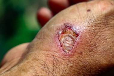 Ellerinde yaralar var ve acıyor.