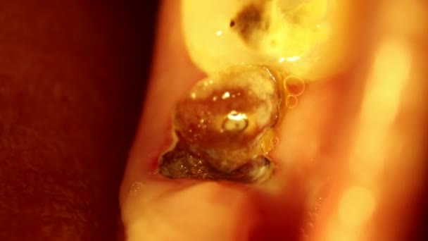 Ubytki Złamane Zęby Bolesne — Wideo stockowe