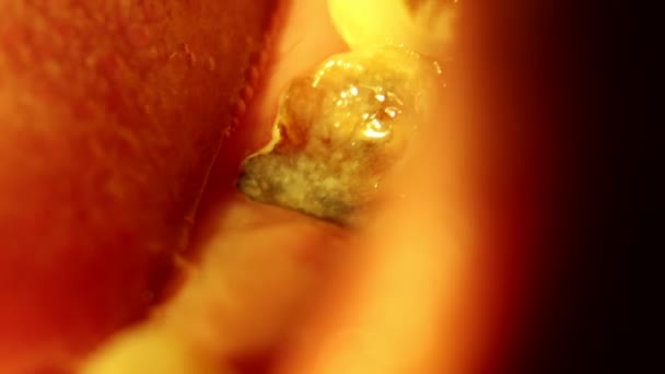 Cavità Denti Rotti Sono Dolorosi — Video Stock