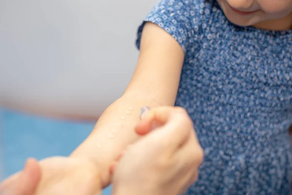 Children\'s allergic skin test for a child\'s hand. Laboratory at the Allergy clinic. Clinical study. Close-up photo, selective focus