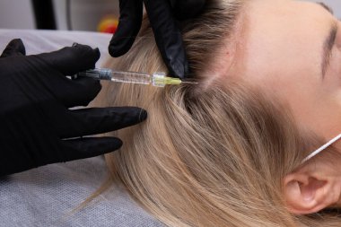 A blonde woman with dyed hair suffers from hair loss and receives mesotherapy injections in her head. Hair restoration concept clipart