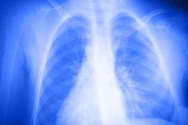 X-ray photograph of lungs clipart