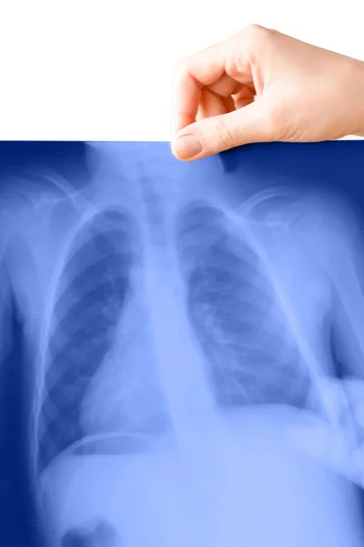 Fotografía de rayos X de pulmones — Foto de Stock