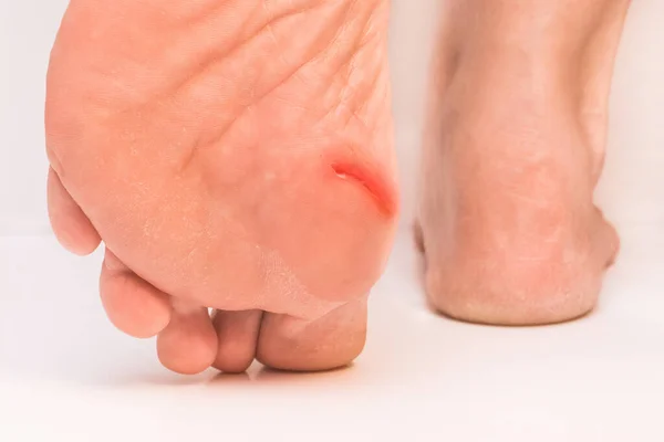 白い背景に足に傷のある高齢女性の足 クローズアップ — ストック写真
