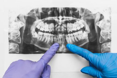 Koruyucu eldiven takmış bir erkek ve kadın doktorun elleri, bir röntgen görüntüsünde alt çenenin hafif kıvrımlı olduğunu gösteriyor..