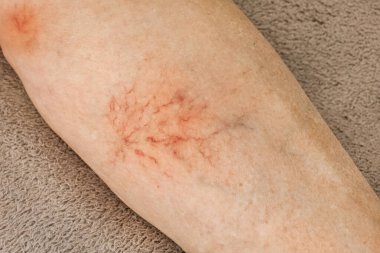 Varicose veins, sore female leg, venous disease.