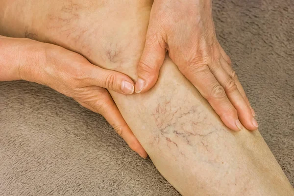 高齢女性の手は 静脈瘤 病気の女性の足に表示されます — ストック写真