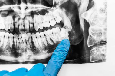 Bir doktorun eli, tıbbi eldiven parmağıyla alt çenedeki yirmilik dişlerinin büyümesini gösterir. Ağız boşluğunun röntgen görüntüsü, yakın plan..