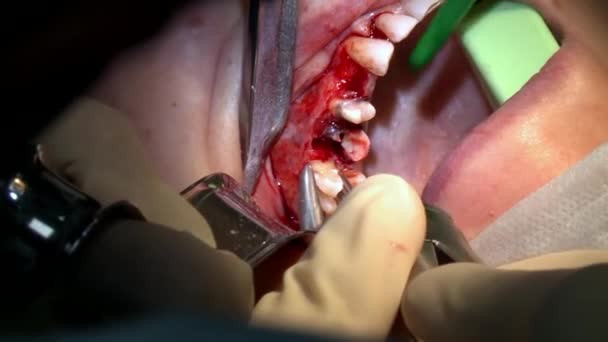 Medico professionista fare il trattamento dei denti un paziente in ambulatorio ambulatoriale moderna sala operatoria utilizza moderne attrezzature dentali e anestesia. Primi piani di chirurgia dentale orale e maxillo-facciale. — Video Stock