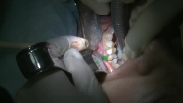 El estomatólogo hace la eliminación de los empastes dentales un paciente en el quirófano moderno de la clínica de la oficina utiliza equipos dentales modernos y anestesia. Cuidados dentales de cerca Cirugía de implantes orales y maxilofaciales. — Vídeos de Stock