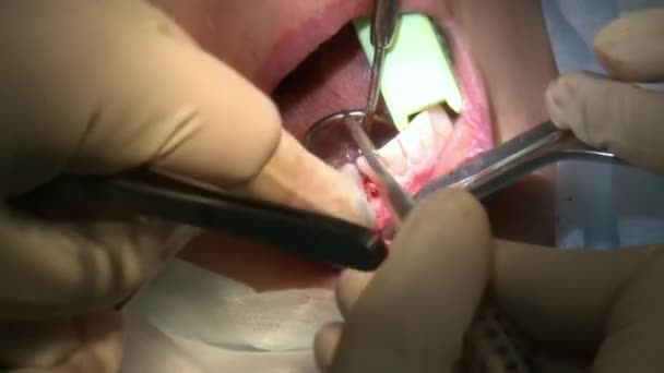 Il chirurgo fa uso di denti di perforazione un paziente in ambulatorio ambulatoriale moderna sala operatoria utilizza moderne attrezzature dentali e anestesia. Primi piani di chirurgia dentale orale e maxillo-facciale. — Video Stock