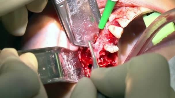 Stomatolog wykonuje instalację implantu stomatologicznego, a pacjent w nowoczesnej sali operacyjnej gabinetu wykorzystuje nowoczesny sprzęt stomatologiczny i znieczulenie. Zbliżenie opieki stomatologicznej implanty jamy ustnej i szczękowo-twarzowej. — Wideo stockowe