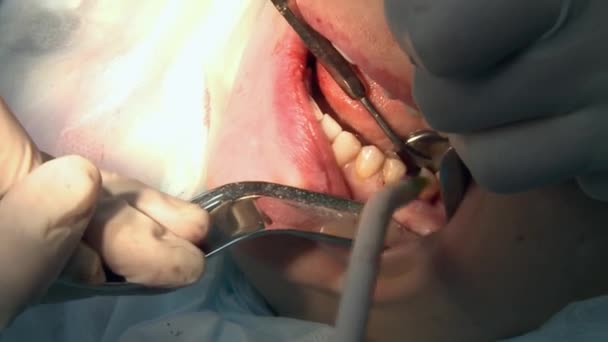 Chirurg verwijdert bloed een patiënt in moderne kantoor kliniek operatiekamer maakt gebruik van moderne tandheelkundige apparatuur en verdoving. Close-up mond- en maxillofaciale implantaatchirurgie. — Stockvideo
