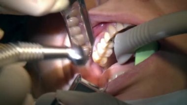 Stomatolojist modern ofis kliniğinde diş sökme ameliyatı yapan bir hastayı modern diş teçhizatı ve anestezi kullanıyor. Kapalı diş bakımı oral ve maksimum yüz implantı ameliyatı.