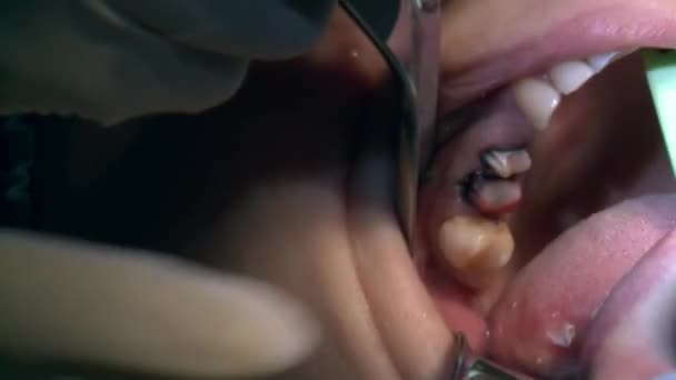 Lo stomatologo fa la rimozione dei denti un paziente nella moderna sala operatoria dello studio utilizza moderne attrezzature dentali e anestesia. Primi piani di chirurgia dentale orale e maxillo-facciale. — Video Stock