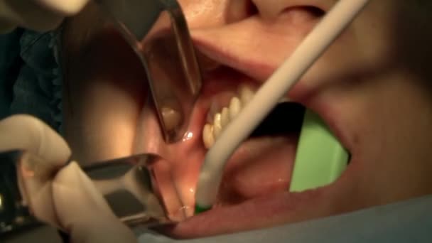 Stomatolog usuwa ząb pacjenta w nowoczesnej sali operacyjnej gabinetu wykorzystuje nowoczesny sprzęt stomatologiczny i znieczulenie. Zbliżenie opieki stomatologicznej implanty jamy ustnej i szczękowo-twarzowej. — Wideo stockowe