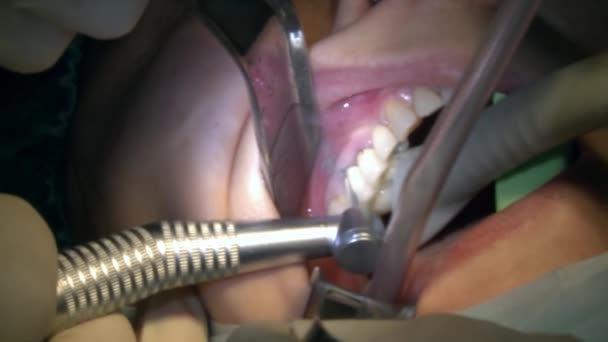 Zahnarzt tun Zahnentfernung ein Patient in modernen Büro Klinik Operationssaal verwendet moderne zahnärztliche Ausrüstung und Anästhesie. Close-up Zahnpflege Mund- und Kieferchirurgie Implantat. — Stockvideo